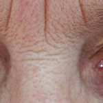 Belmo - clouding of the cornea of ​​the eye