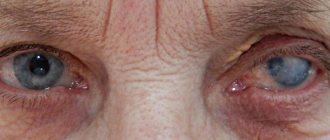 Belmo - clouding of the cornea of ​​the eye